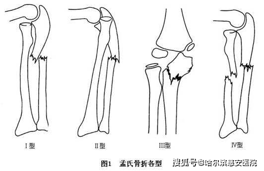 尺骨茎突骨折分型图片