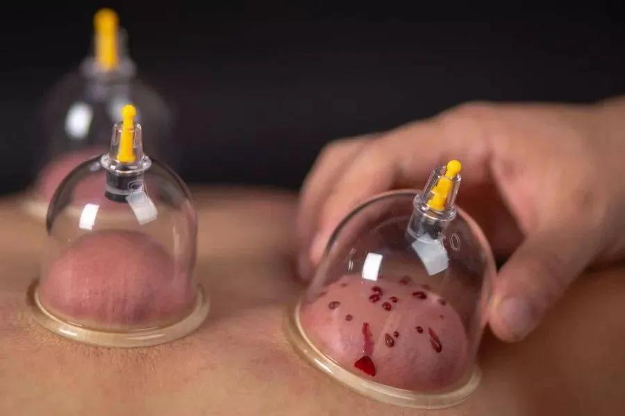 1,十二井穴:即十二经络之井穴部位;主治:卒中,急性炎症,退热等2,十宣