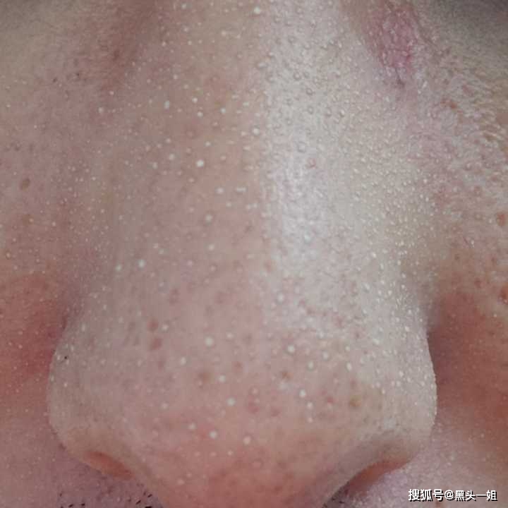 有什么平价又好用的去黑头方法?要真平价,又真好用的!