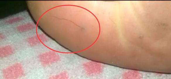 奇闻女子感觉脚底疼一看发现有一条黑色东西看清后哭笑不得