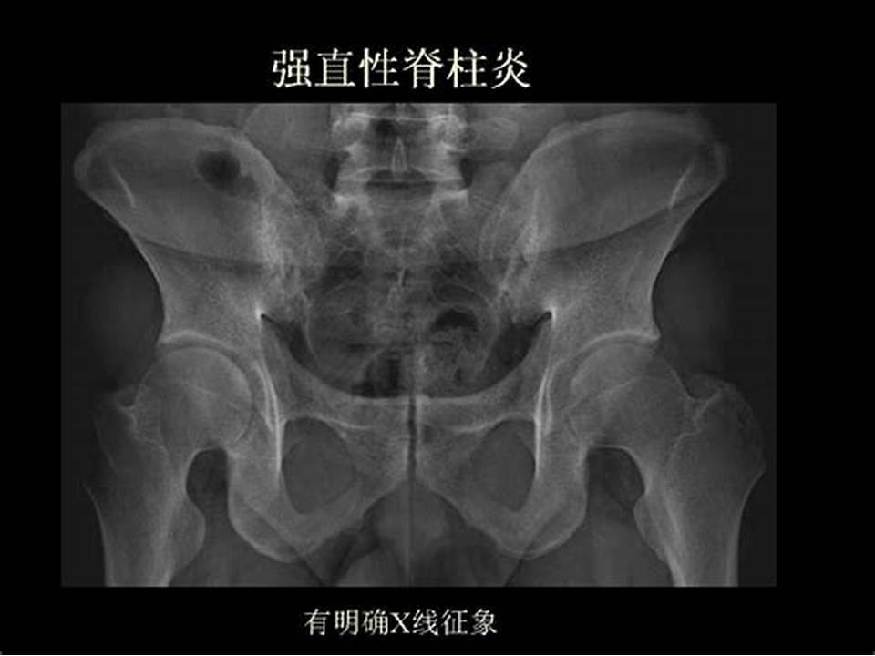 孩子出现腿部疼痛,会不会得了强直性脊柱炎呀!