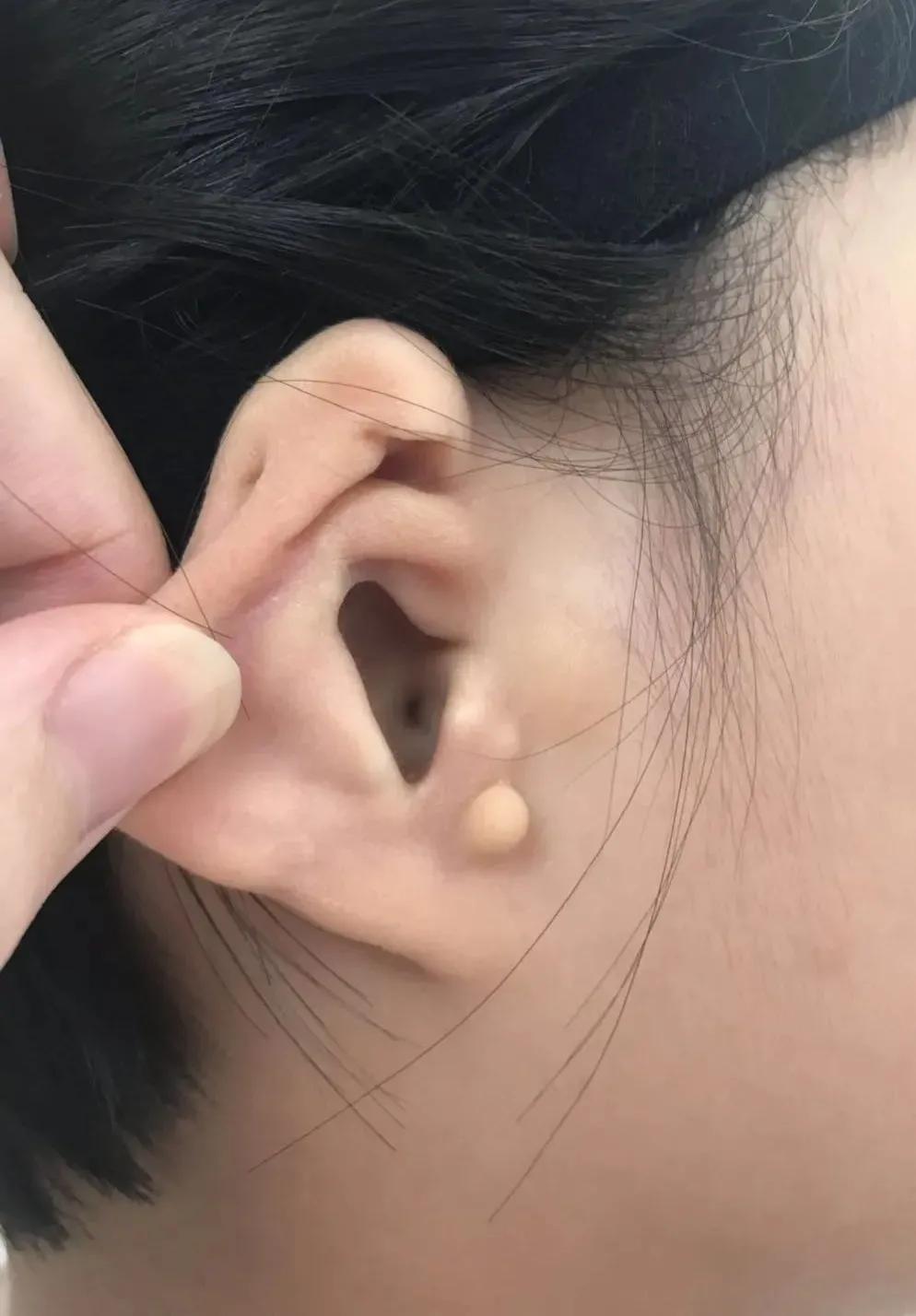 梁平惠耳先天性小耳畸形听力干预or外耳整形她亲身经历告诉您什么最