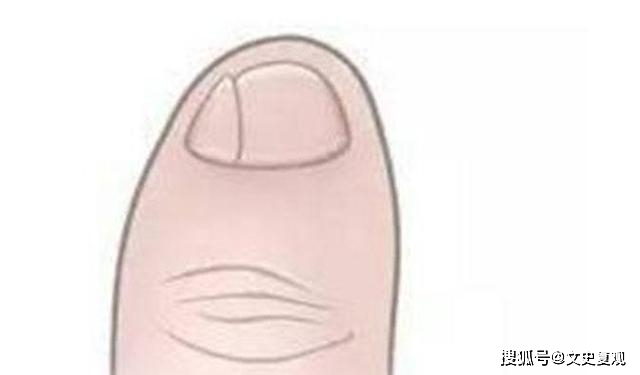 科学解释小脚趾甲两瓣图片