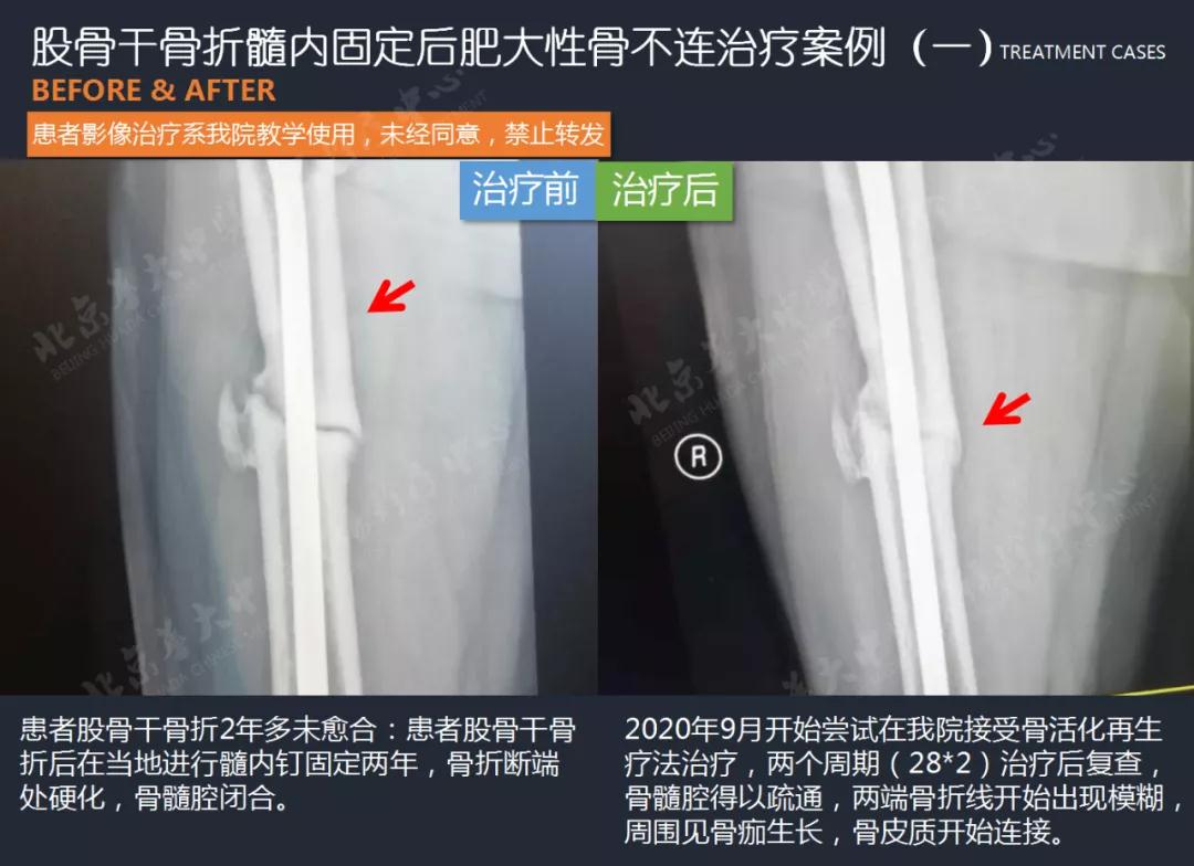 患者骨髓腔得以疏通,兩端骨折線開始出現模糊,周圍見骨痂生長,骨皮質