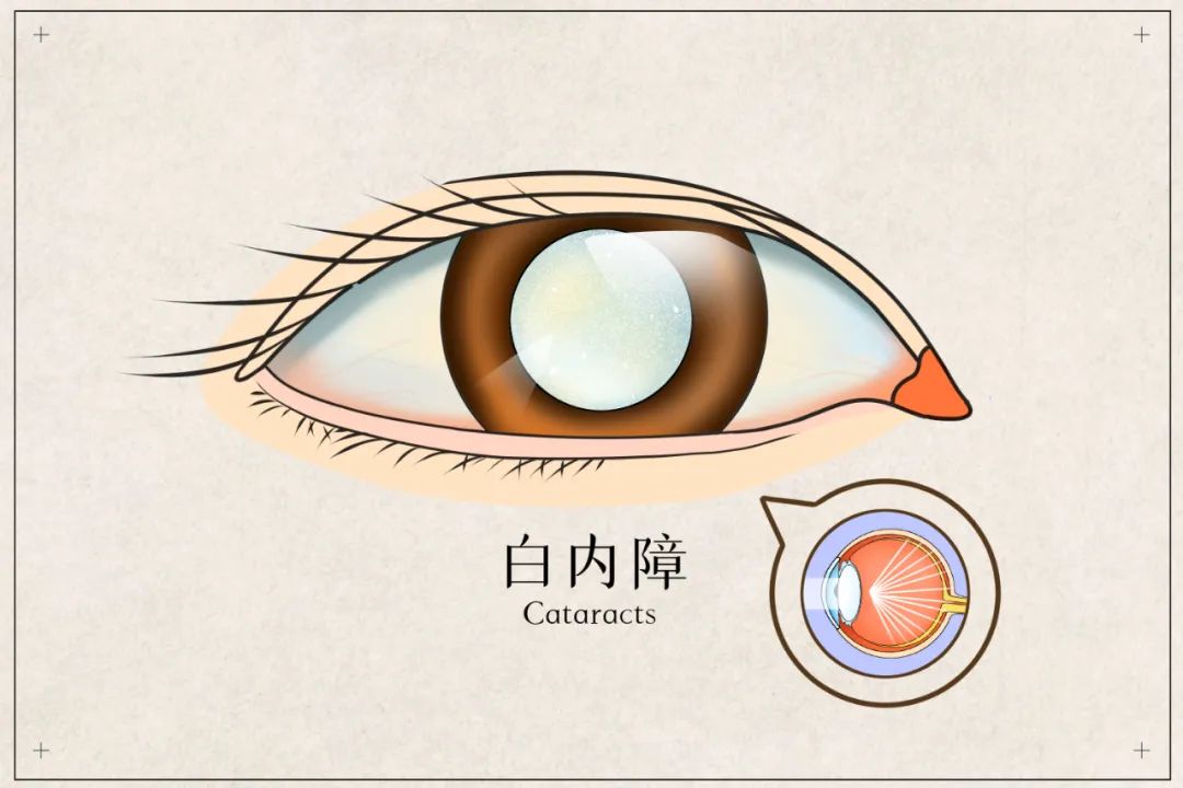 別拖了冬季才是告白好時機廈門眼科中心白內障手術迎來小高峰