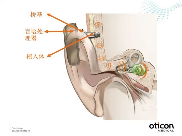 骨传导助听器,由言语处理器,桥基,钛质植入体三部分组成.