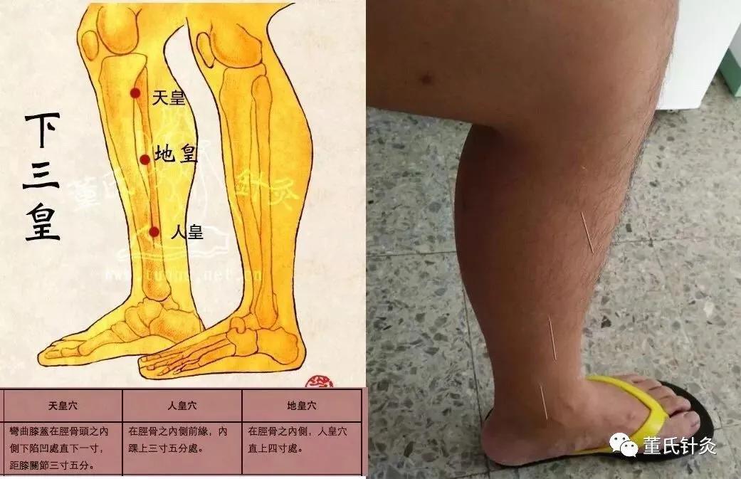 天皇穴】 部位:在脛骨頭之內側陷中,去膝關節二寸五分.