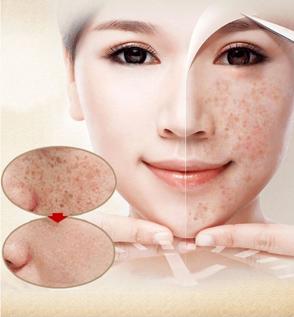 资深祛斑专家的30条冬季护肤秘诀,有钱难买!