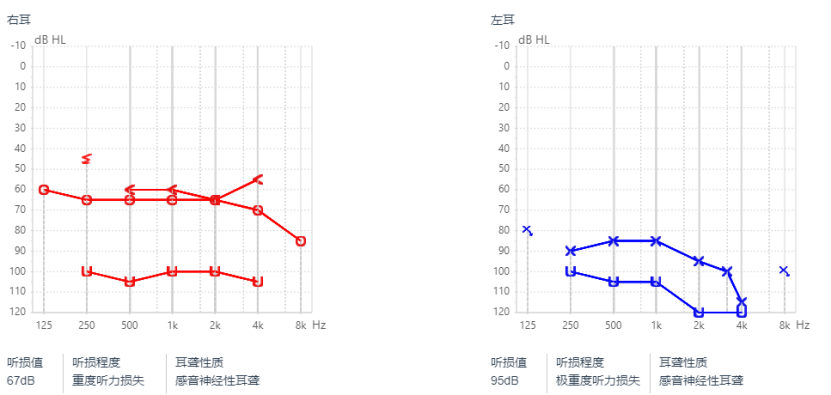 怎么知道听力损失重不重听力图怎么看白话翻译验配师专业术语