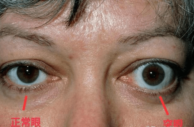 眼征:部分患者出现突眼,上眼睑挛缩,睑裂增宽,眼球运动异常