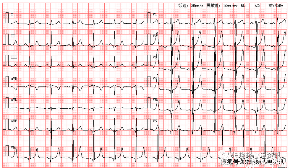 心电图rv5和sv1的范围图片