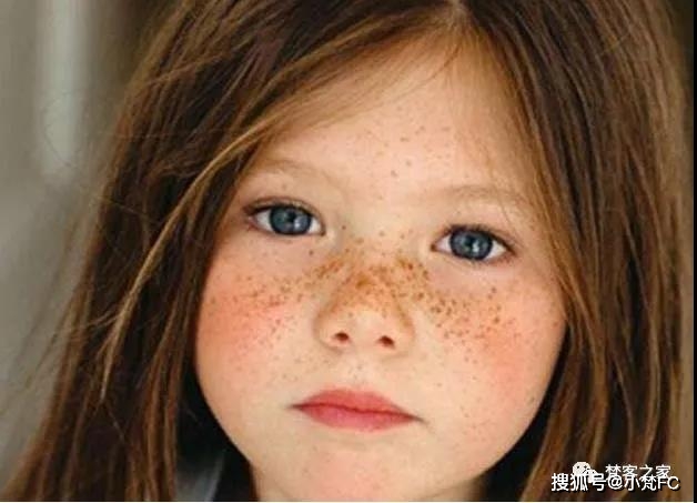 【皮肤管理】黄褐斑,雀斑,晒斑的区别_手机搜狐网