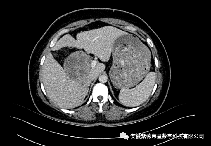 山東大學齊魯醫院成功完成一例複雜原發性下腔靜脈平滑肌肉瘤切除