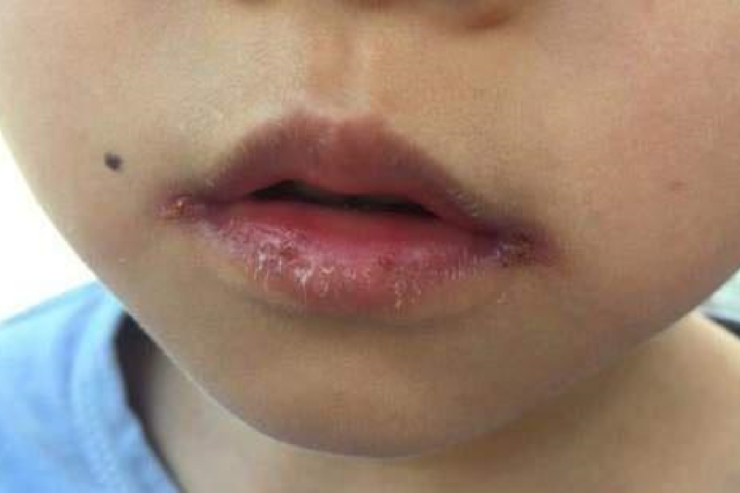 孩子总是"撕嘴皮",是干燥还是强迫症,两者不同对策要了解_手机搜狐网