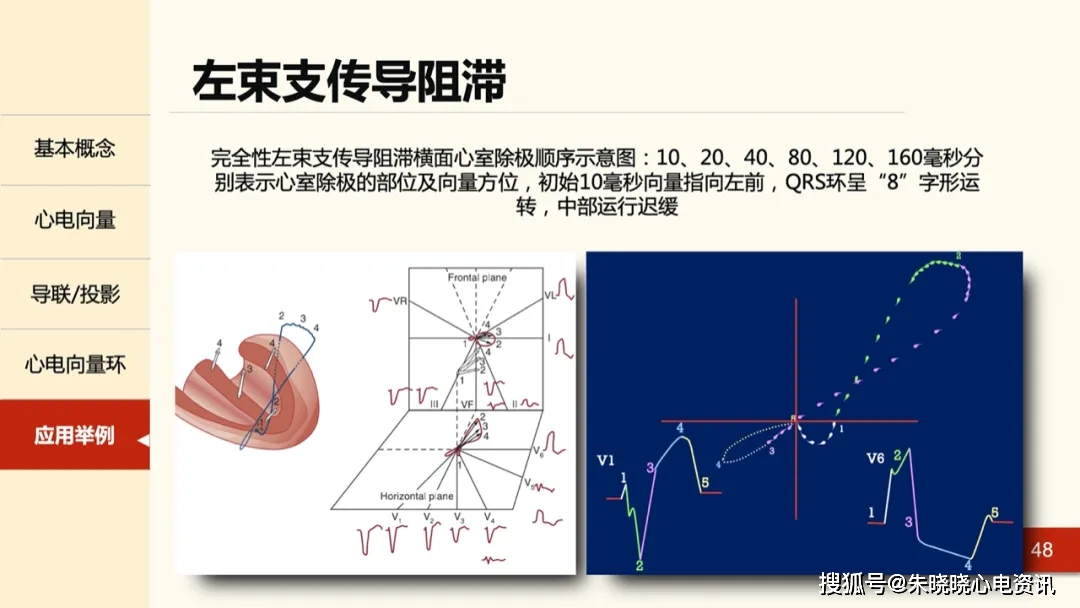 一文掌握心電向量從基本原理到臨床應用