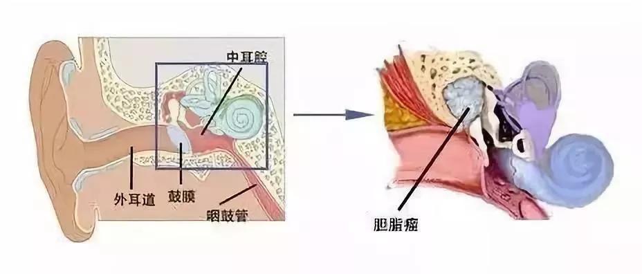 貴陽銘仁耳鼻喉醫院膽脂瘤是不是瘤看這一篇文章就夠了