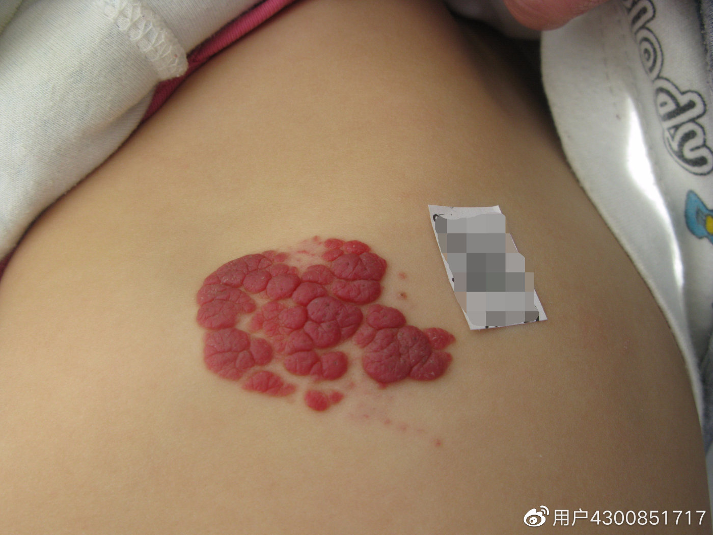 宝宝血管瘤初期图片图片