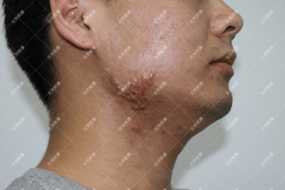 下巴有像鸡皮疙瘩(下巴大面积小疙瘩像鸡皮)