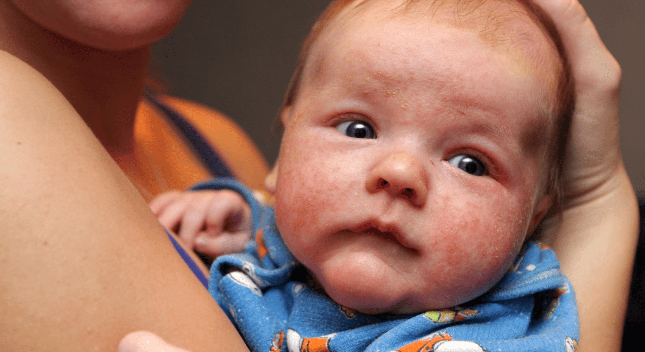 婴儿湿疹最佳治疗方法 一般湿疹多久会消失