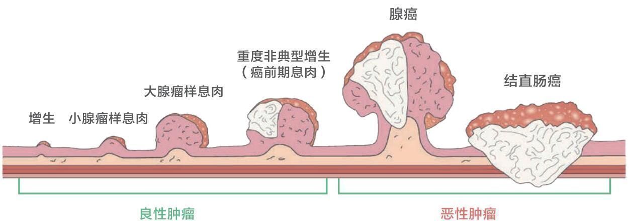 大便反复便血?小心是直肠癌