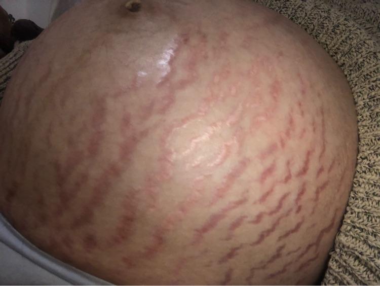 妊娠纹初期图图片