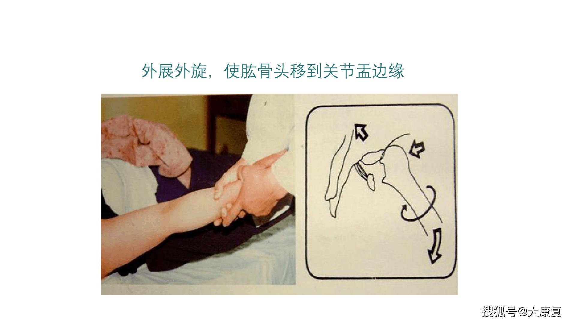 肩关节前脱位介绍