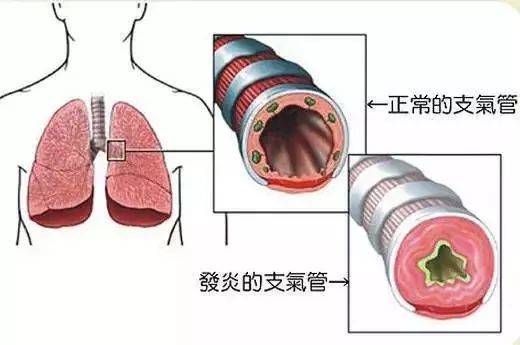 治疗原理是什么意思_根管治疗是什么意思