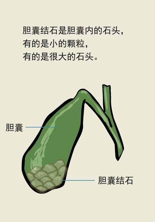 胆囊里面长满 金豆子 双镜联合为患者解除危机 苗庆松