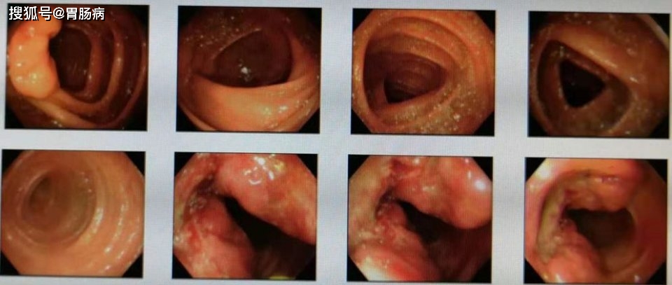 肠镜痛苦吗图片