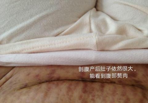 剖腹产后恶露多久排完产妇恶露排不干净可能和4个因素有关