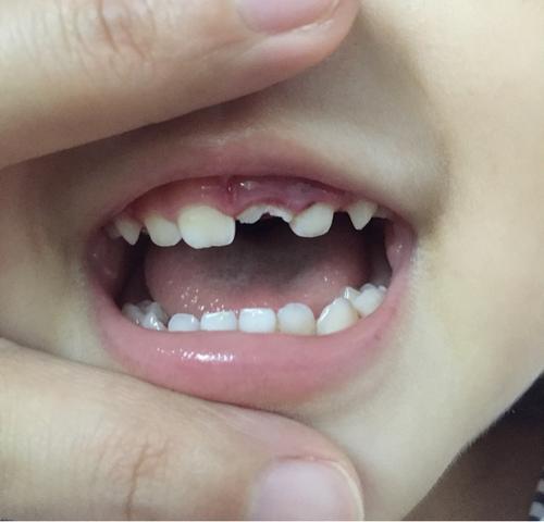 被角,枕角及吮吸奶嘴等,因为在咬这些物体的时候一般总固定在牙齿的某