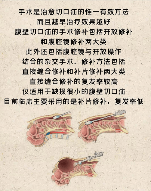 疝病专家董擂带你了解腹壁切口疝的治疗_手术