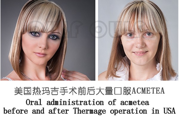 温度深扒做热玛吉全脸部价格表~
