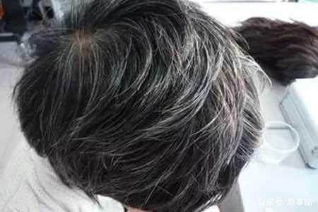 白头发能变黑可信吗 90f981dc1286474cb0b0246063fcaf99.jpeg