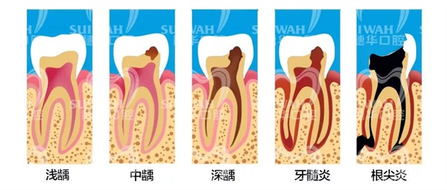 什么程度可以补牙 cfa420b6fa4a41939dd5213ffb2e8645.jpeg