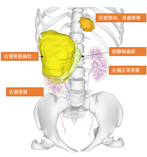 00後女大學生確診腎癌晚期醫生提醒這些千萬別碰