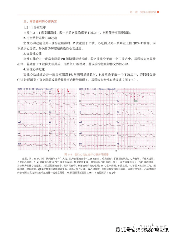 如何鉴别巨大倒置t波?