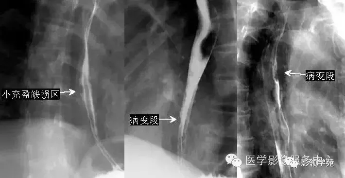 10種食管鋇餐常見疾病圖解