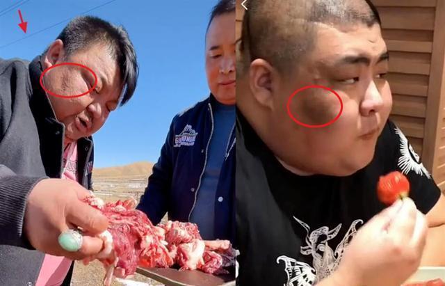 网红吃播泡泡龙去世不久,又有一个吃播出现类似征兆,暴饮暴食身体不堪