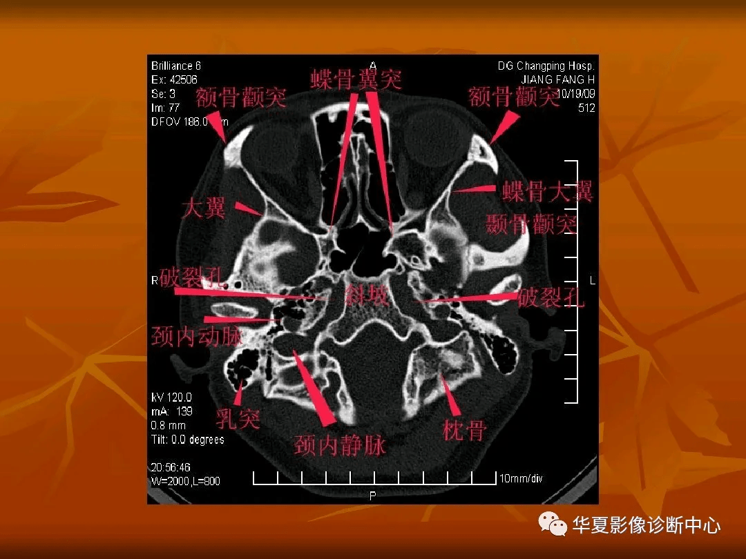 顱底ct高清圖解 常見骨折部位圖示