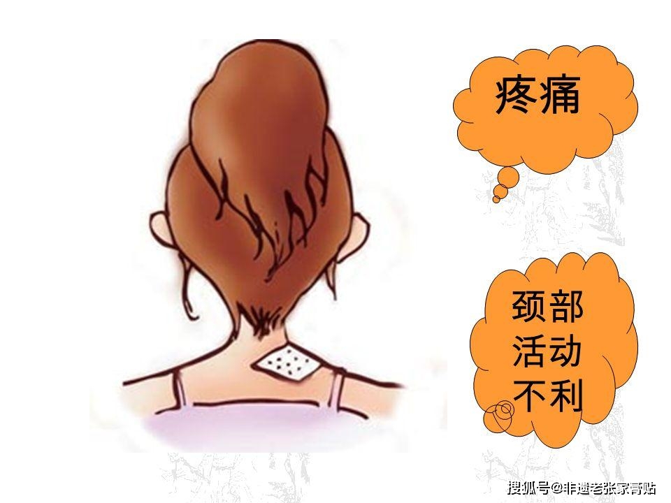 落枕脖子不能动怎么办