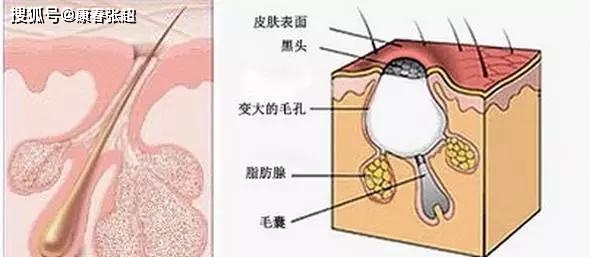 涂什么可以破坏毛囊 5ebd423f1a094dcdb7f28457fdc3d6e2.jpeg