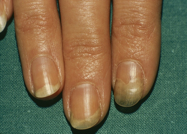 竖起中指测测肝脏健康若有3个表现可能是肝硬化在作祟