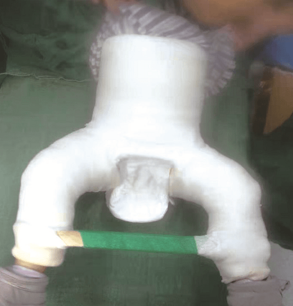 (先天性髋关节脱位实行蛙状石膏治疗)襁褓法是早期预防ddh的关键.3.