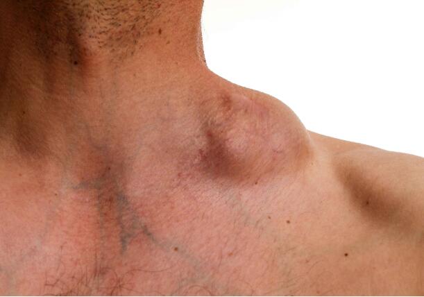 后背肩胛骨酸胀癌症图片