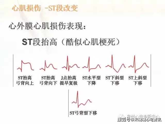 心肌缺血和心肌梗死的心电图改变(ppt)