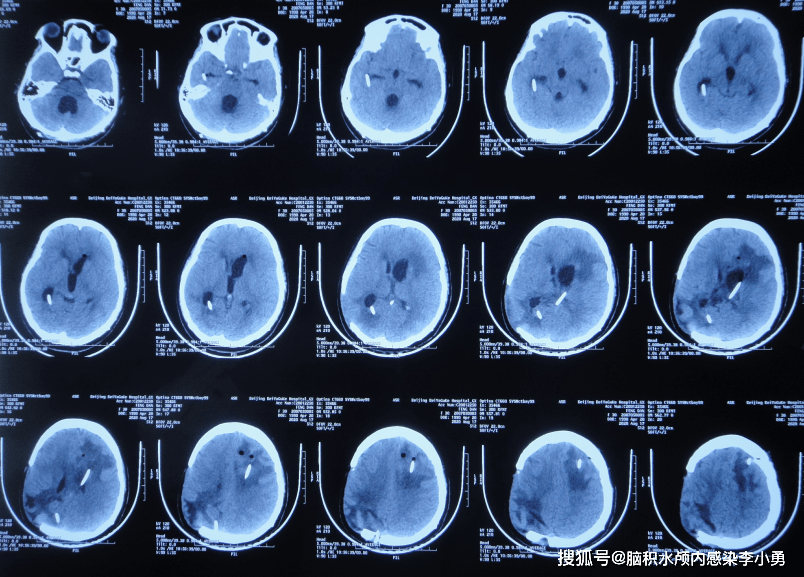 2020年8月17日入院治疗54天即2020年8月29日,查头颅ct侧脑室,第四脑室
