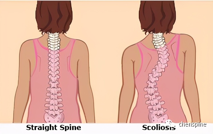 老人腰痛,下肢麻痛,警惕腰椎退变侧弯找上门!