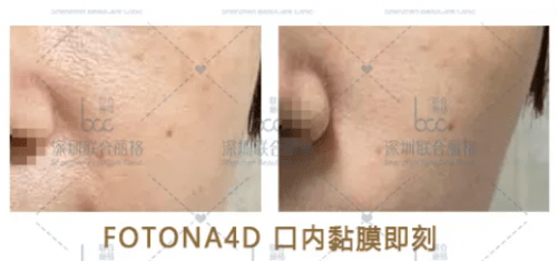 激光|同属抗衰激光，fotona4d与5gmax怎么选？