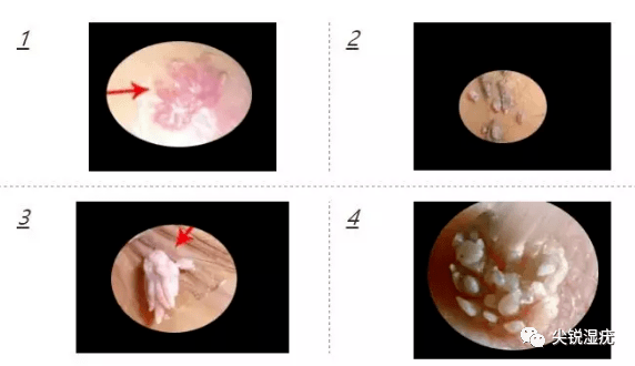 尖锐湿疣医院排名(2)